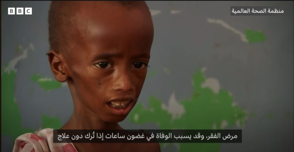 الكوليرا